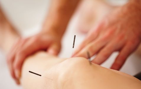 What is Dry Needling: How is it Different to Acupuncture?