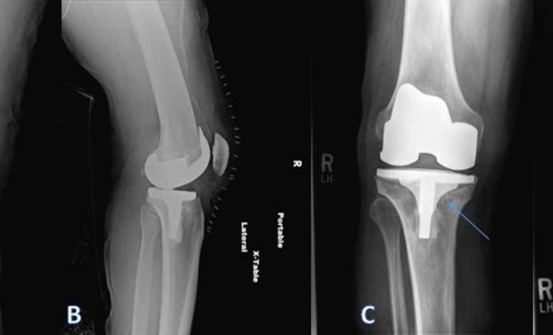 When to get a Total Knee Replacement (TKR)